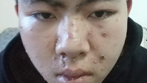 水痘视频,病毒传播、症状及预防措施