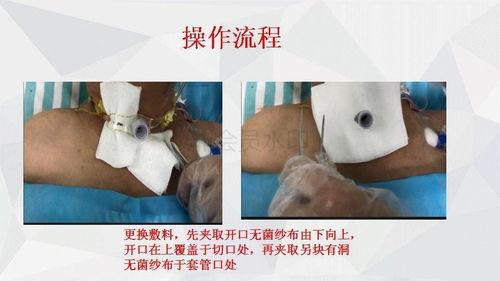 换药视频,轻松掌握伤口换药技巧