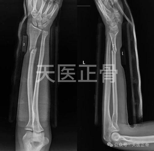 骨折复位视频,直观展示复位技巧与步骤