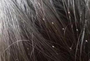 虱子视频,揭秘人类头虱与体虱的生存之道