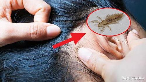 虱子视频,揭秘人类头虱与体虱的生存之道
