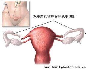 女性输卵管结扎手术视频,女性输卵管结扎手术全过程解析