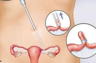 女性输卵管结扎手术视频,女性输卵管结扎手术全过程解析