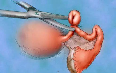 女性输卵管结扎手术视频,女性输卵管结扎手术全过程解析