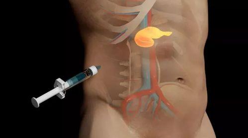 胰岛素注射视频教程