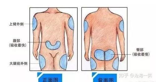 胰岛素注射视频教程