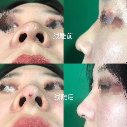 线雕鼻取线视频,轻松掌握美丽秘诀