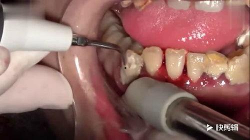洗牙的视频,专业视频带你了解口腔清洁新体验