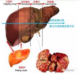 脂肪肝视频,揭秘成因、症状及防治策略